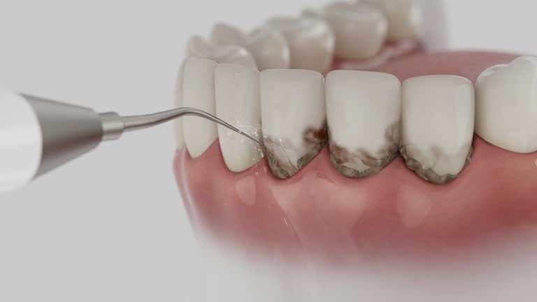 Trusted Wisdom Tooth Removal service in Galveston, TX - Dentist Open Now
